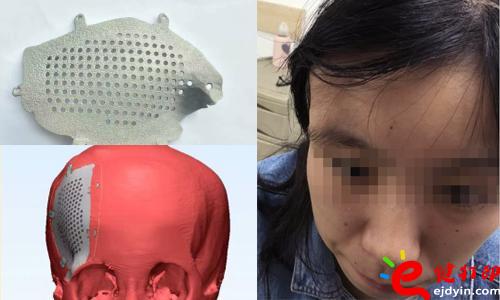 醫(yī)療3d打印應(yīng)用,醫(yī)用3d打印,3D打印假肢,3D打印脊椎,3D打印心臟,e鍵打印,3d打印服務(wù) 3D打印的顱骨假體，非常適用于發(fā)際外的顱骨缺損、病變置換，將使患者的面容恢復(fù)到正常形態(tài)，完美解決了傳統(tǒng)顱骨修補(bǔ)存在的美容問(wèn)題。據(jù)悉，3D打印個(gè)性化顱骨假體修補(bǔ)技術(shù)已獲國(guó)家重點(diǎn)研發(fā)計(jì)劃資助，能為一批病人免費(fèi)提供假體，并能減免一些檢查和治療費(fèi)用。未來(lái)將實(shí)行72小時(shí)的3D假體個(gè)性化顱骨修補(bǔ)術(shù)，造福更多的患者。